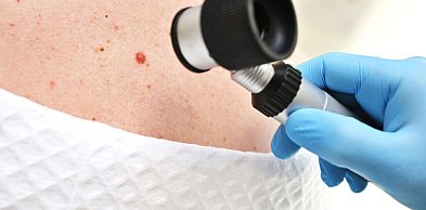 Znamiona podejrzane onkologicznie – kiedy wymagają oceny specjalisty?