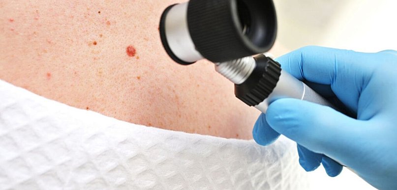 Znamiona podejrzane onkologicznie – kiedy wymagają oceny specjalisty?