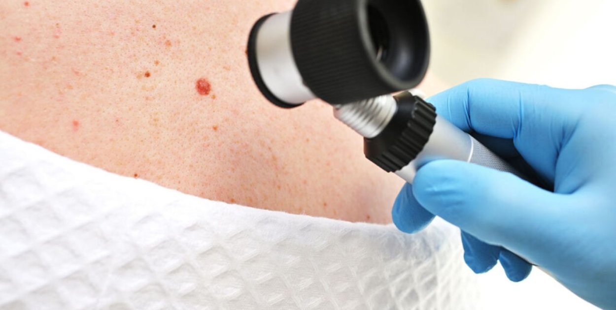 Znamiona podejrzane onkologicznie – kiedy wymagają oceny specjalisty?